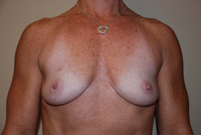 Breast-Reconstruction-Immediate-Implant-02 | Before Breast Reconstruction Immediate Implant