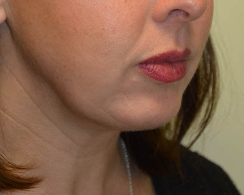 Chin-Augmentation-02 | After Chin Augmentation 2