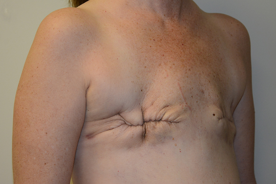 Breast-Reconstruction-TRAM-Flap-02 | Before Breast Reconstruction TRAM Flap 2