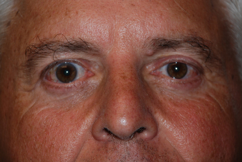 Eyelid-Surgery-03 | After Eyelid Surgery 1