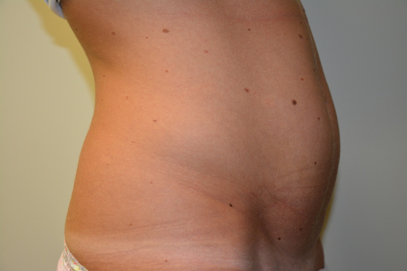 Mini-Tummy-Tuck-02 | Before Mini Tummy Tuck 3