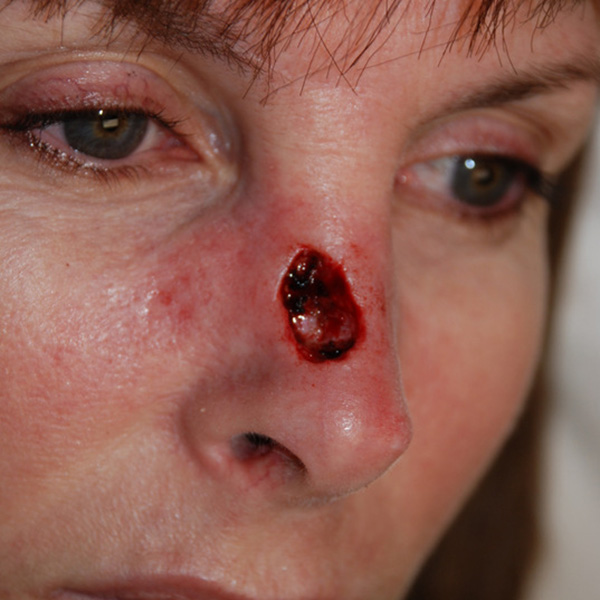 Skin-Cancer-Reconstruction-02 | Before Skin Cancer Reconstruction 2