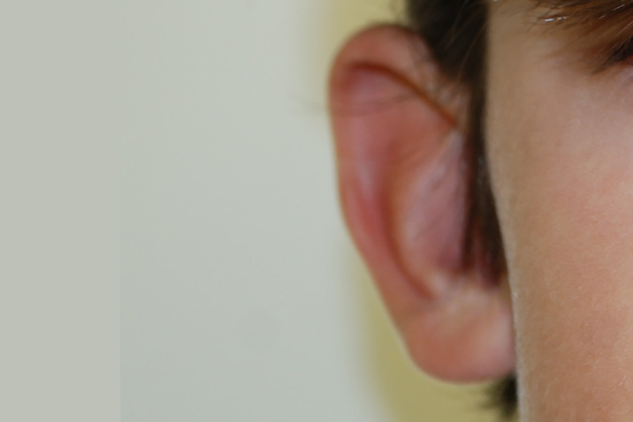 Prominent-Ear-Surgery-02 | Before Prominent Ear Surgery 2