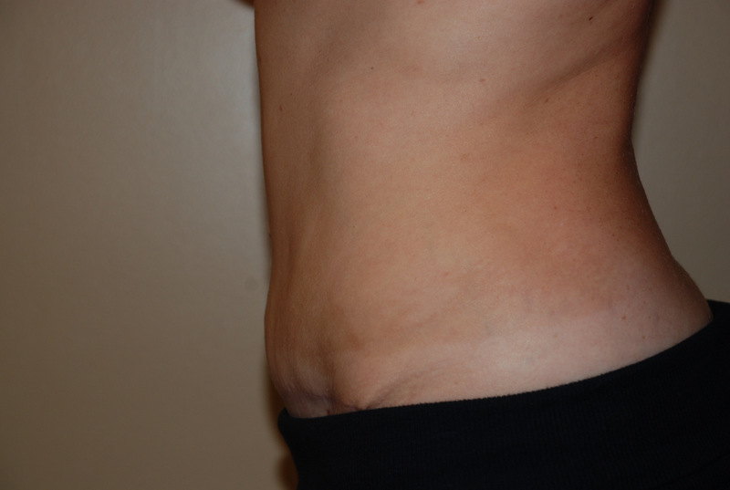 Tummy-Tuck-03 | After Tummy Tuck 3