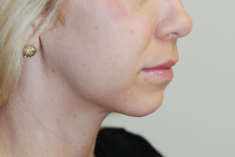 Neck-Liposuction-03 | After Neck Liposuction 2