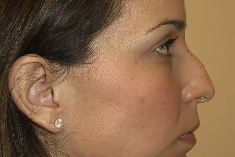 Rhinoplasty-02 | Before Rhinoplasty 2