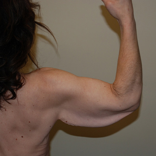 Arm-Lift-02 | Before Arm Lift 2