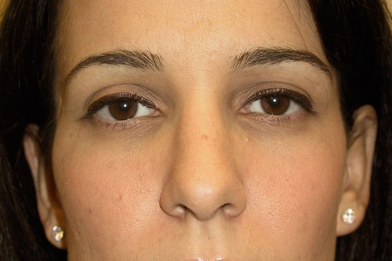 Rhinoplasty-02 | After Rhinoplasty