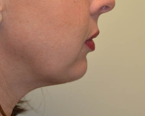 Chin-Augmentation-02 | After Chin Augmentation 3
