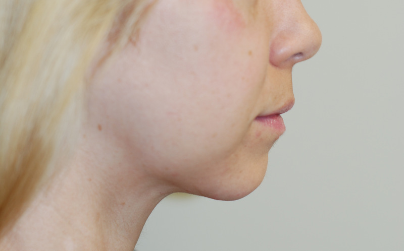 Neck-Liposuction-03 | After Neck Liposuction 3