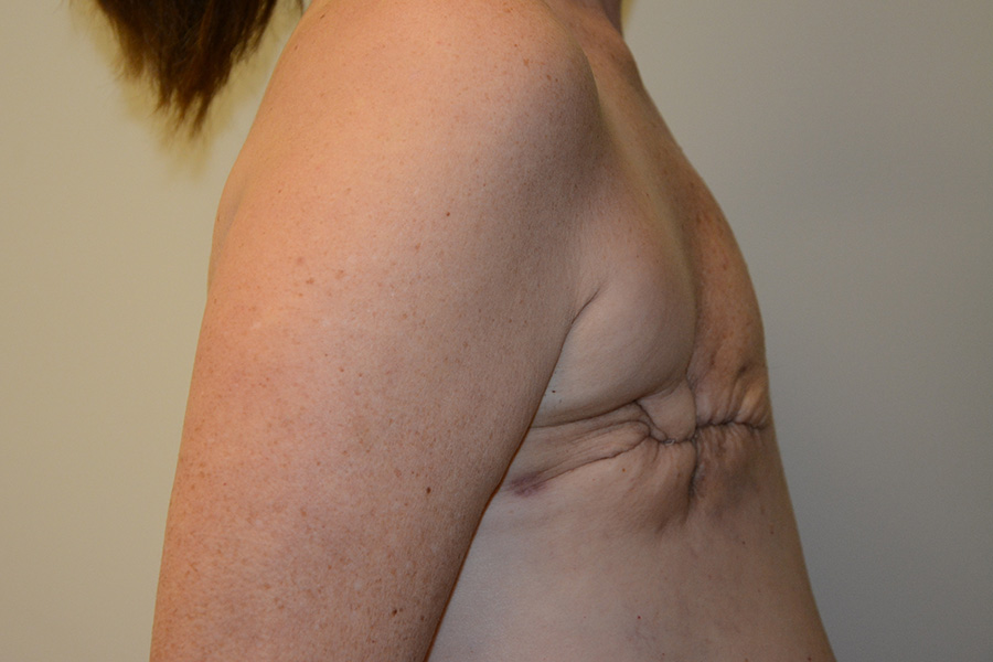 Breast-Reconstruction-TRAM-Flap-02 | Before Breast Reconstruction TRAM Flap 3