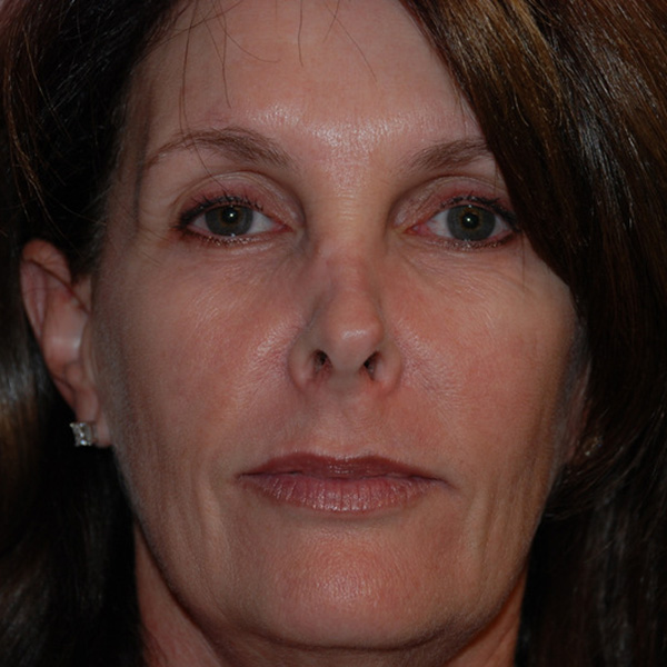 Skin-Cancer-Reconstruction-02 | After Skin Cancer Reconstruction