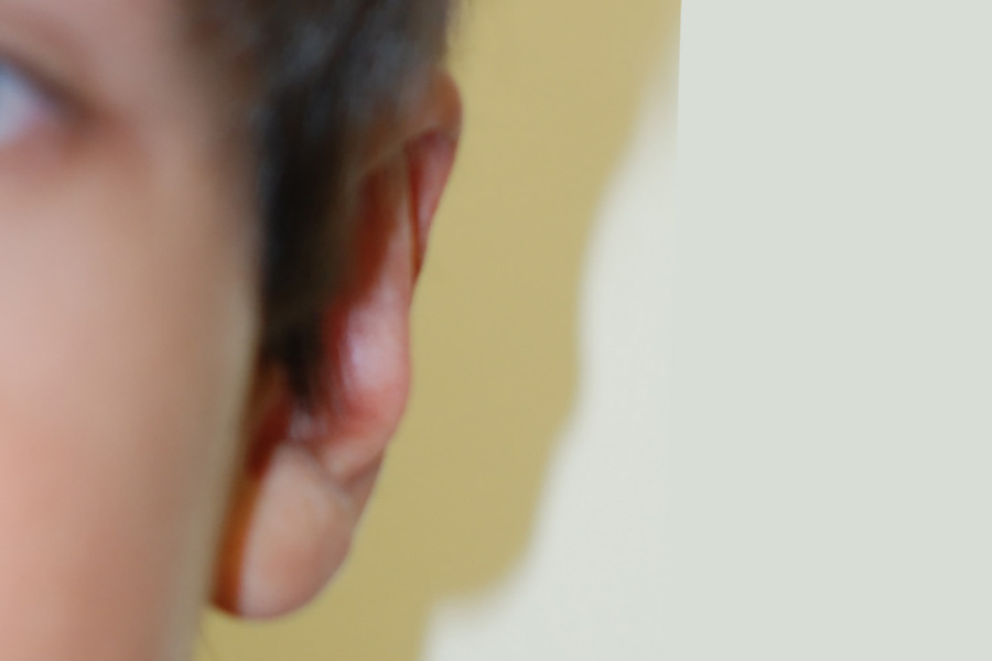 Prominent-Ear-Surgery-02 | After Prominent Ear Surgery