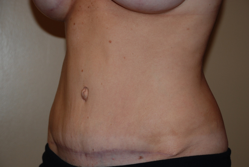 Tummy-Tuck-03 | After Tummy Tuck 2