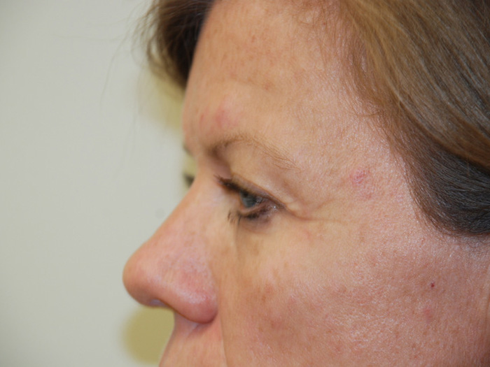 Brow-Lift-02 | Before Brow Lift 4