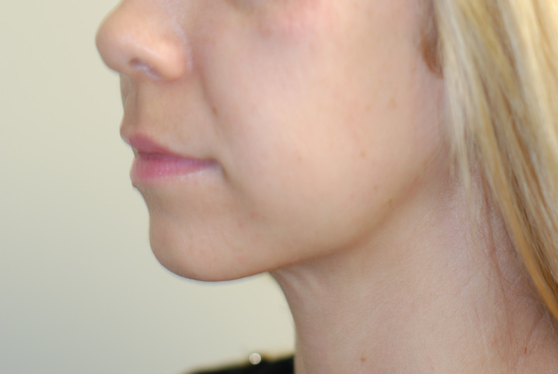 Neck-Liposuction-03 | After Neck Liposuction 4