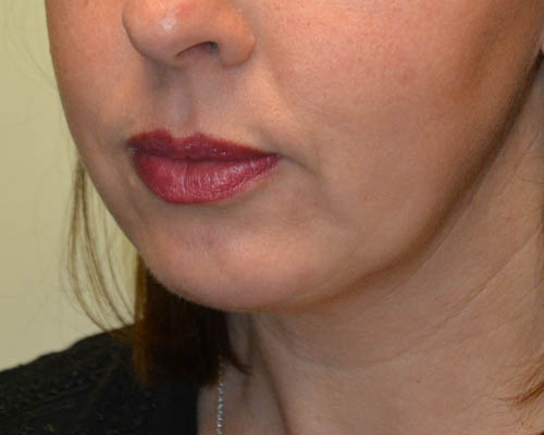 Chin-Augmentation-02 | After Chin Augmentation 4