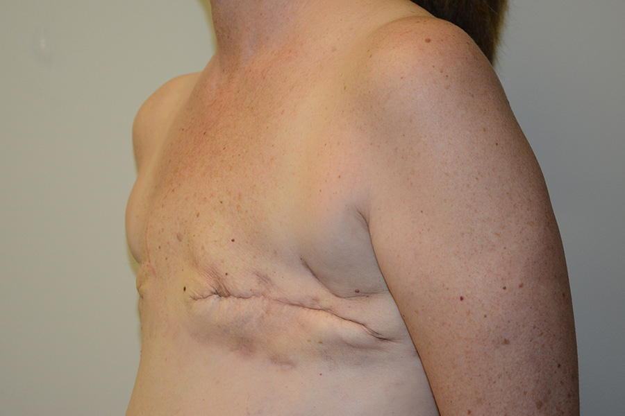 Breast-Reconstruction-TRAM-Flap-02 | Before Breast Reconstruction TRAM Flap 4