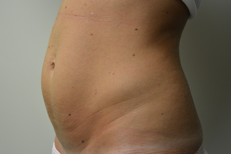 Mini-Tummy-Tuck-02 | Before Mini Tummy Tuck 2