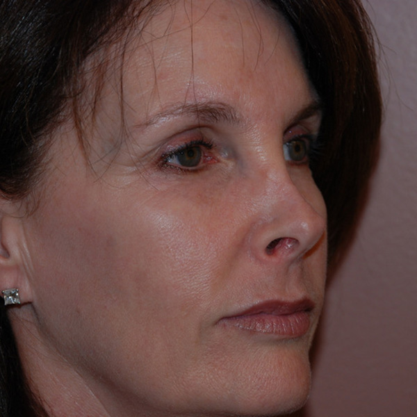 Skin-Cancer-Reconstruction-02 | After Skin Cancer Reconstruction 2