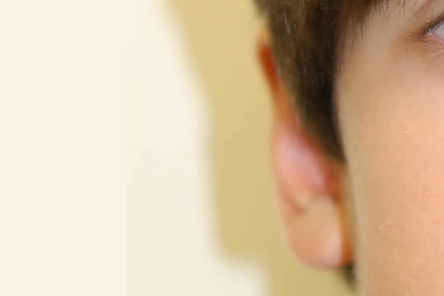 Prominent-Ear-Surgery-02 | After Prominent Ear Surgery 2