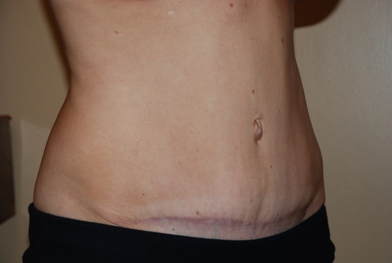 Tummy-Tuck-03 | After Tummy Tuck 4