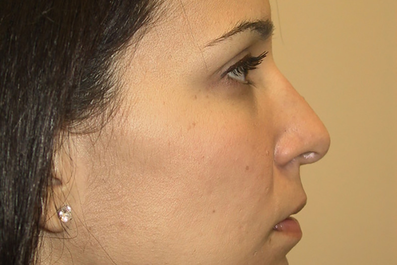 Rhinoplasty-02 | After Rhinoplasty 2