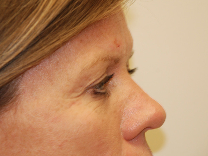 Brow-Lift-02 | Before Brow Lift 5