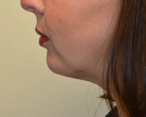 Chin-Augmentation-02 | After Chin Augmentation 5