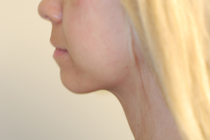 Neck-Liposuction-03 | After Neck Liposuction 5