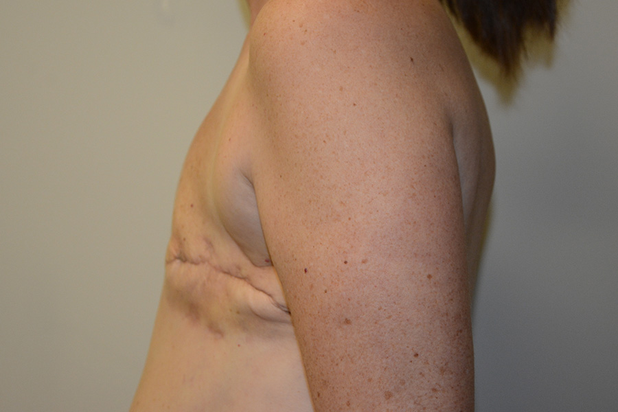 Breast-Reconstruction-TRAM-Flap-02 | Before Breast Reconstruction TRAM Flap 5