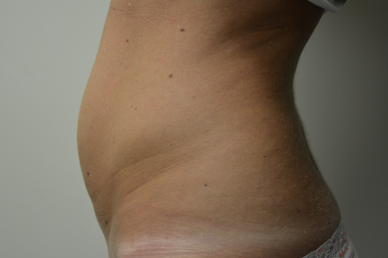 Mini-Tummy-Tuck-02 | Before Mini Tummy Tuck 4