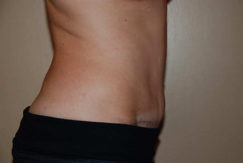 Tummy-Tuck-03 | After Tummy Tuck 5