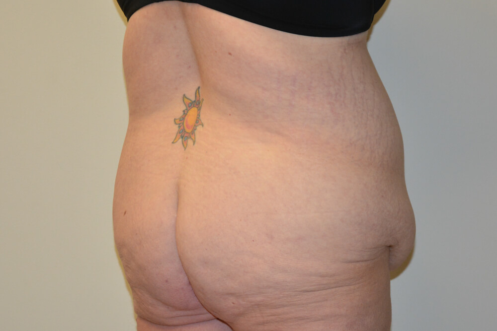 Body-Lift-02 | Before Body Lift 5