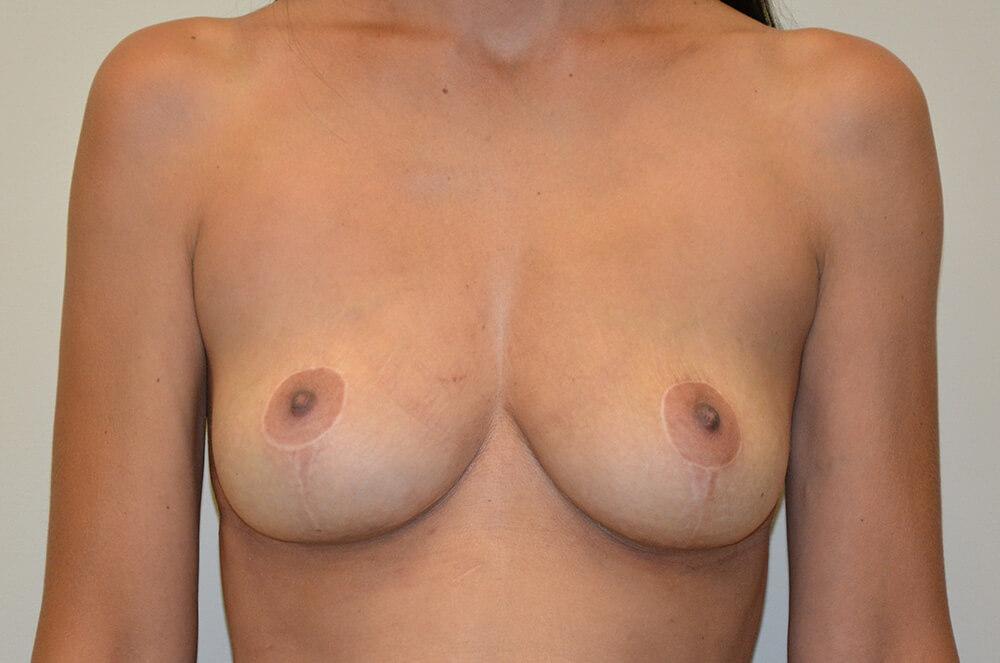 Implant-Removal-03 | After Implant Removal