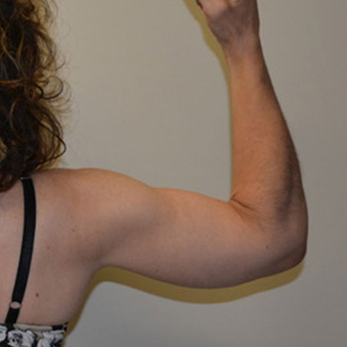 Arm-Lift-02 | After Arm Lift 2