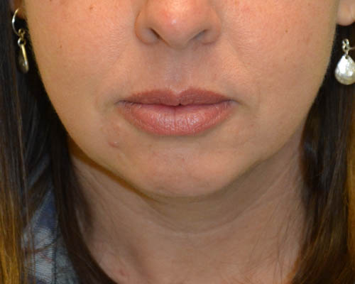Chin-Augmentation-02 | Before Chin Augmentation