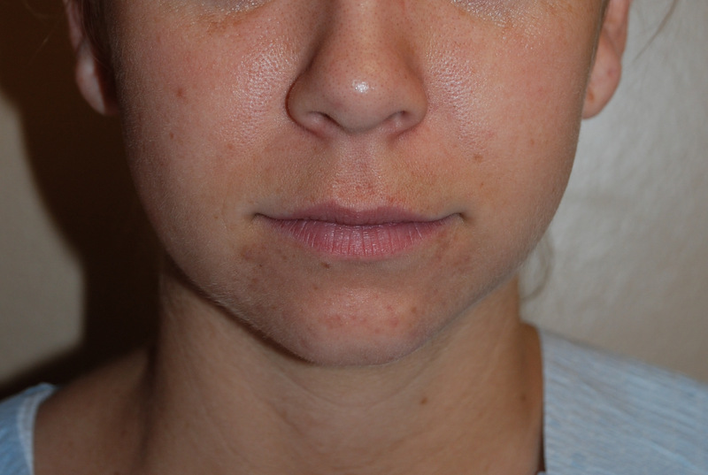 Neck-Liposuction-03 | Before Neck Liposuction