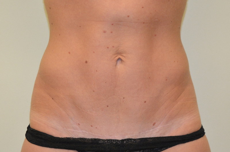 Mini-Tummy-Tuck-02 | After Mini Tummy Tuck 1