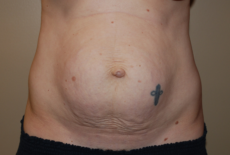 Tummy-Tuck-03 | Before Tummy Tuck
