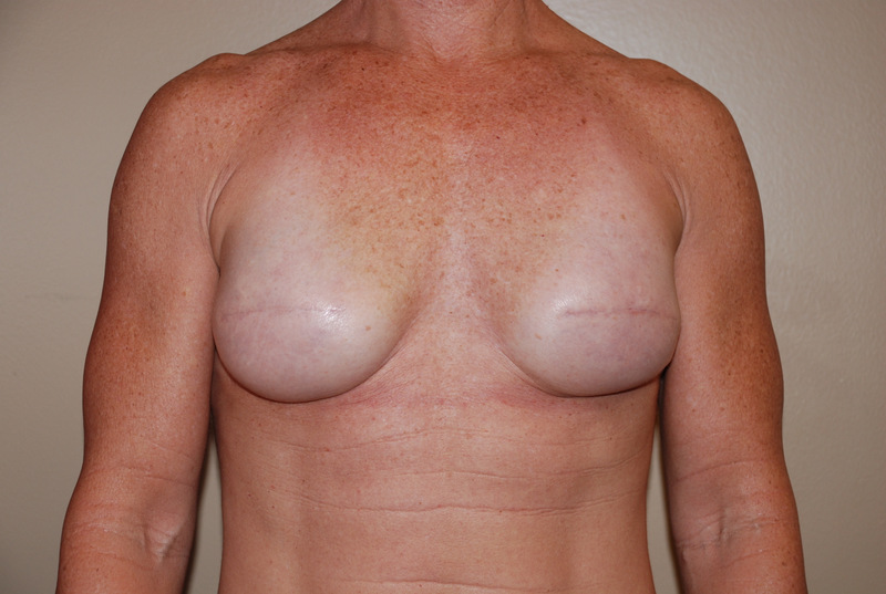 Breast-Reconstruction-Immediate-Implant-02 | After Breast Reconstruction Immediate Implant
