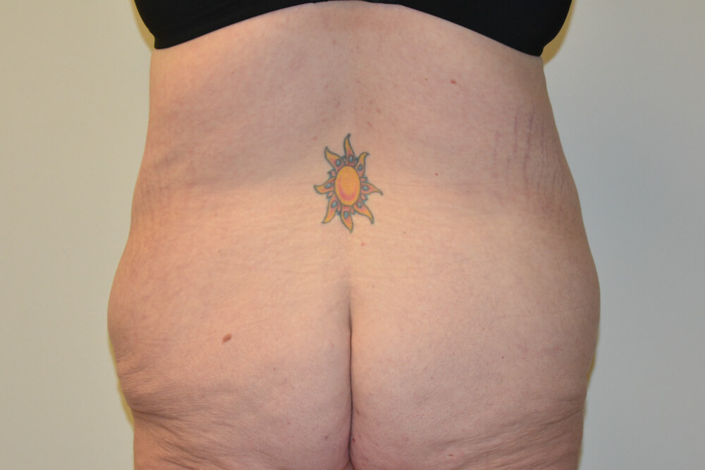 Body-Lift-02 | Before Body Lift 6