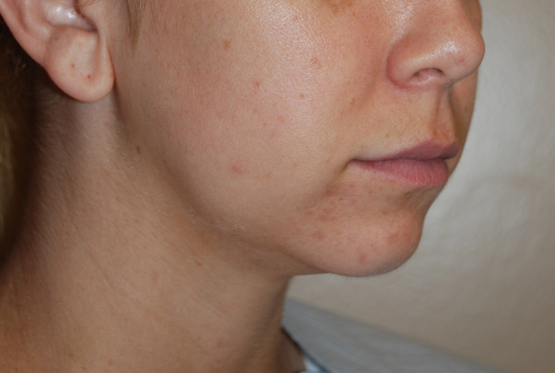 Neck-Liposuction-03 | Before Neck Liposuction 2