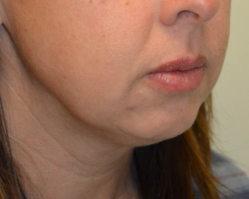 Chin-Augmentation-02 | Before Chin Augmentation 2