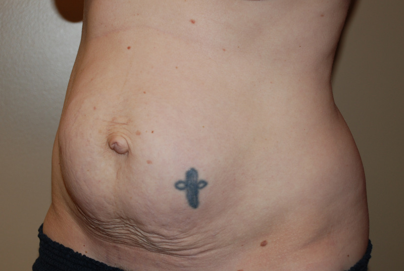 Tummy-Tuck-03 | Before Tummy Tuck 2