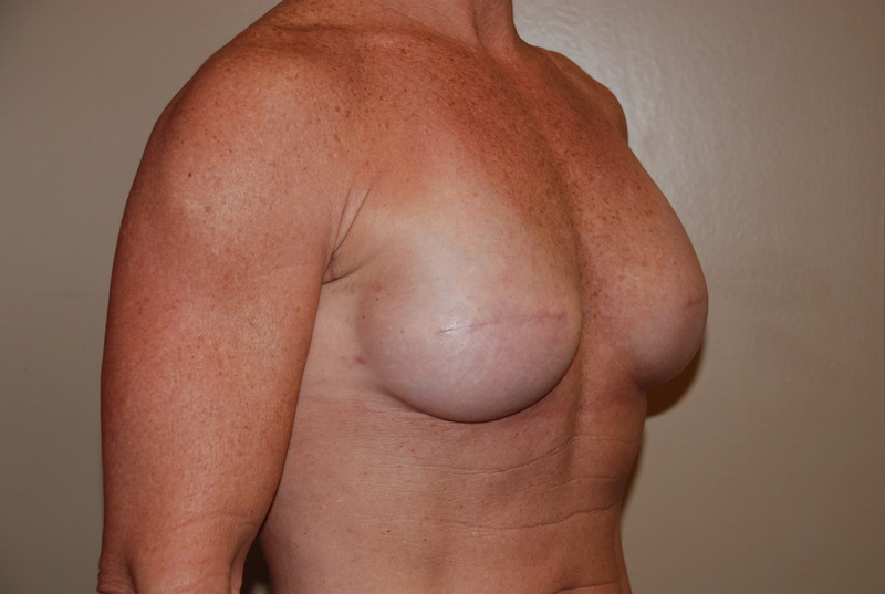Breast-Reconstruction-Immediate-Implant-02 | After Breast Reconstruction Immediate Implant 2