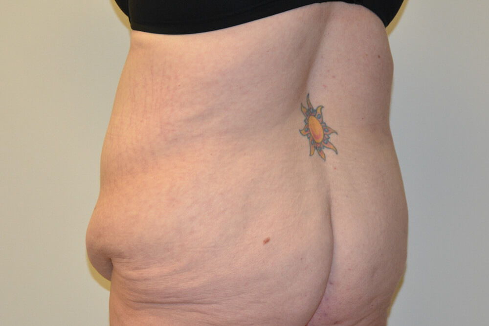 Body-Lift-02 | Before Body Lift 7
