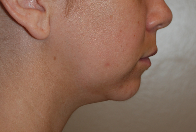 Neck-Liposuction-03 | Before Neck Liposuction 3