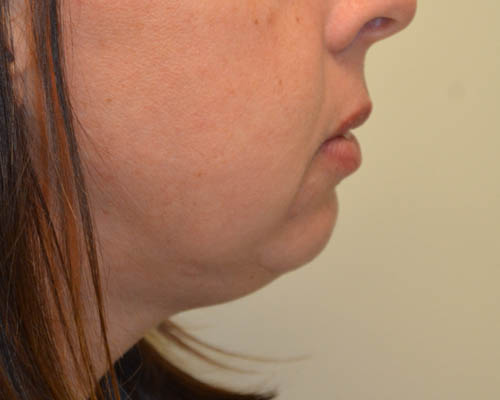 Chin-Augmentation-02 | Before Chin Augmentation 3