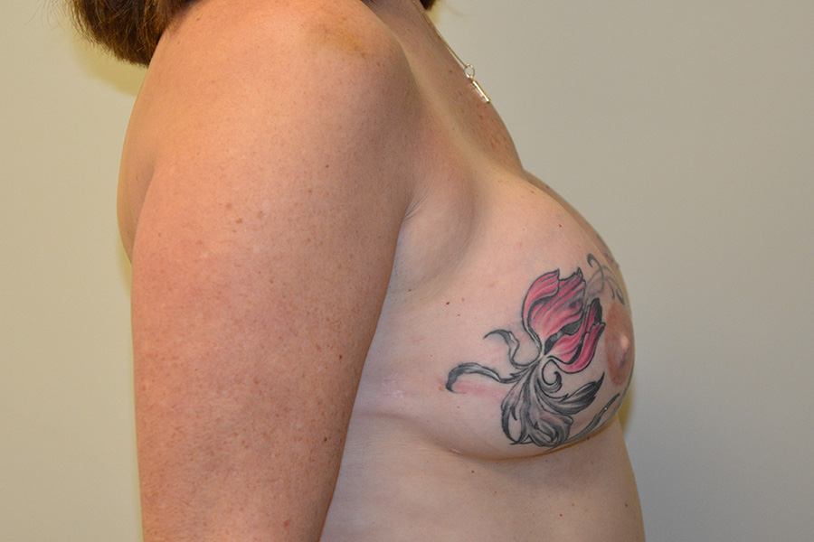 Breast-Reconstruction-TRAM-Flap-02 | After Breast Reconstruction TRAM Flap 3